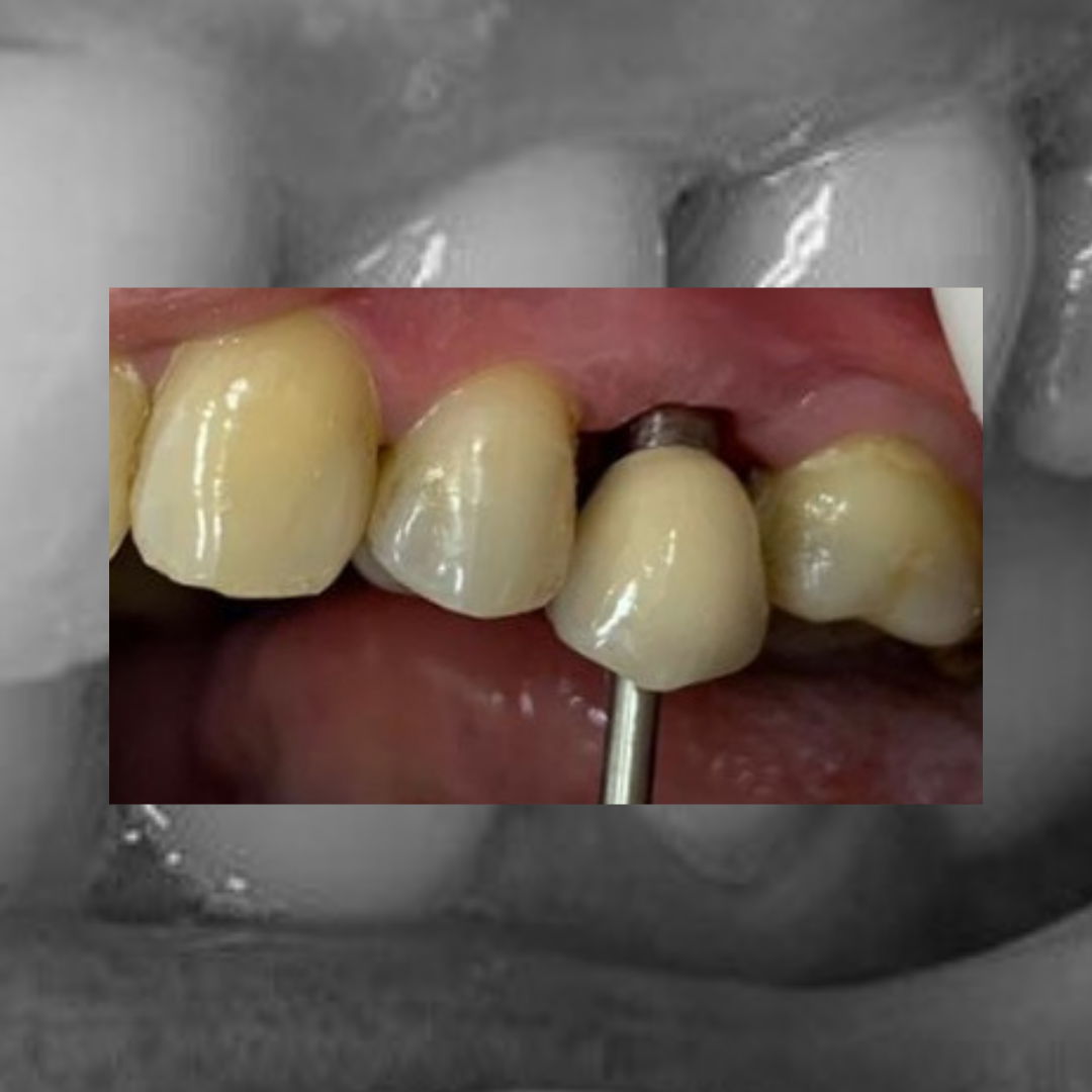 Coroa dentária em prova sobre o implante