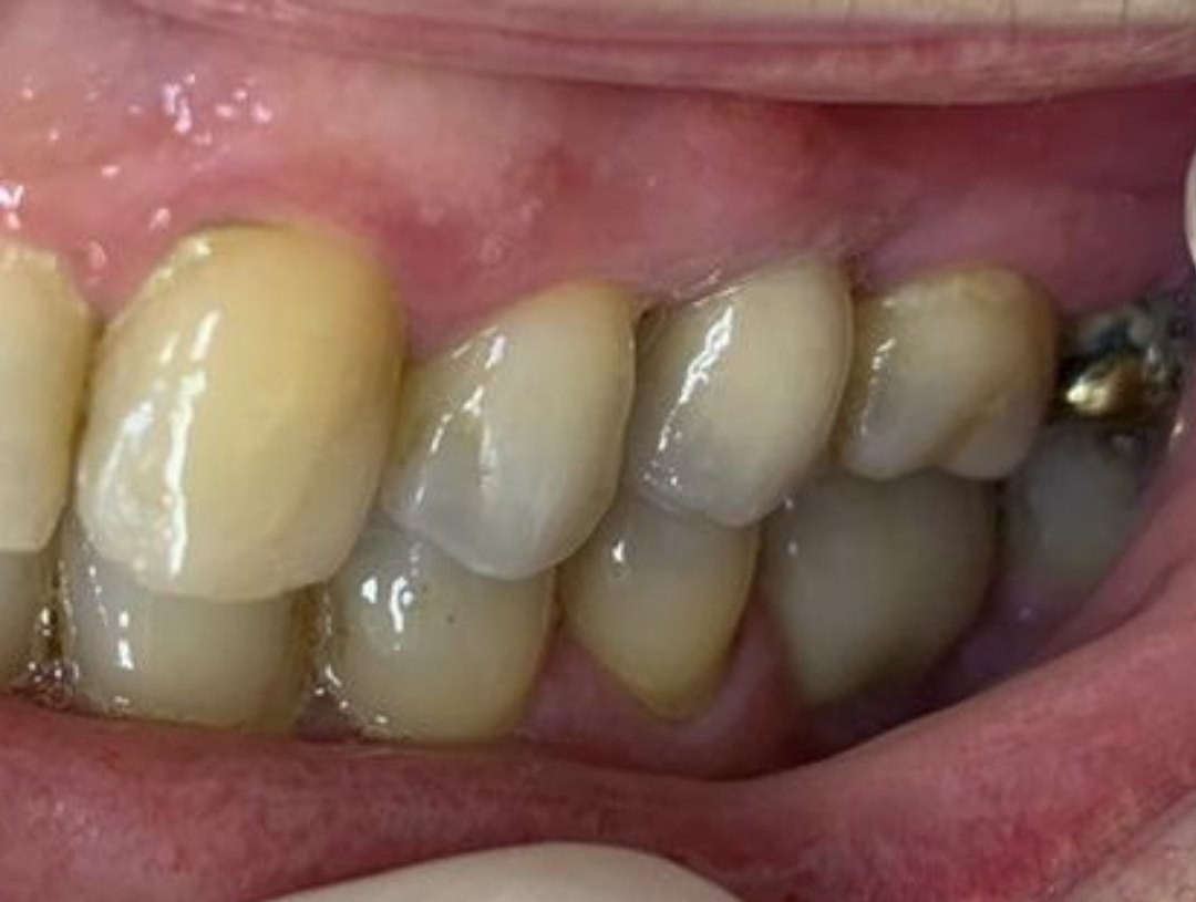 Dentes após a reabilitação protética