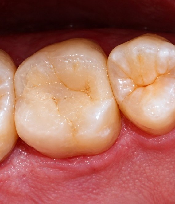 Foto clínica do molar reabilitado após o tratamento de canal