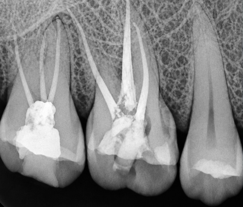 Radiografia periapical com o tratamento de canal concluído nos molares superiores
