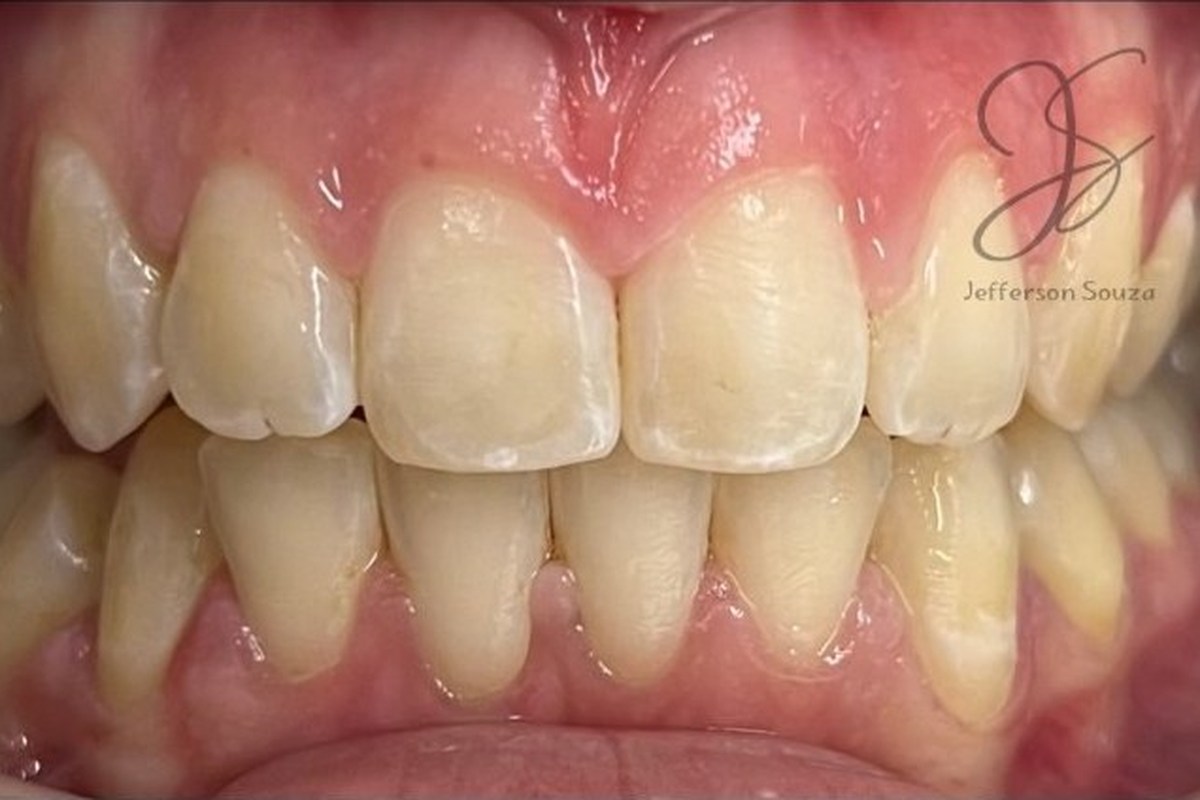 Registro intraoral antes do clareamento dental