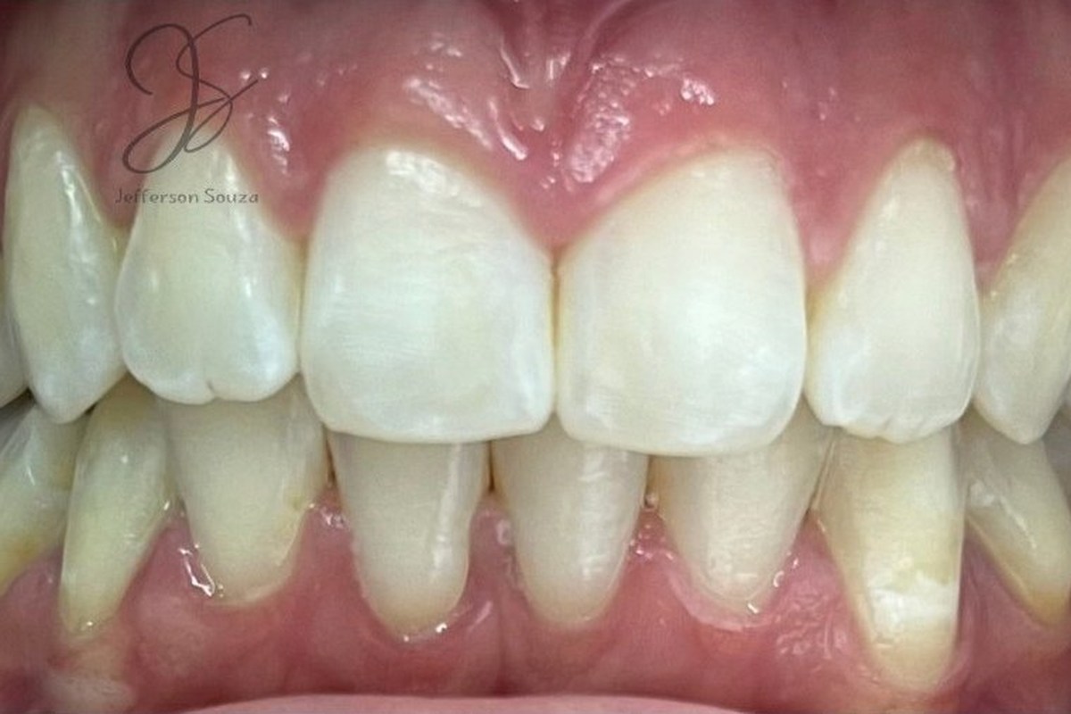 Registro intraoral do mesmo paciente após o clareamento dental